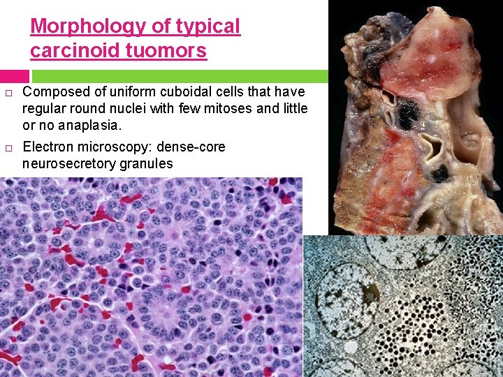 Morphology of typical carcinoid tuomors Composed of uniform cuboidal cells that have regular round