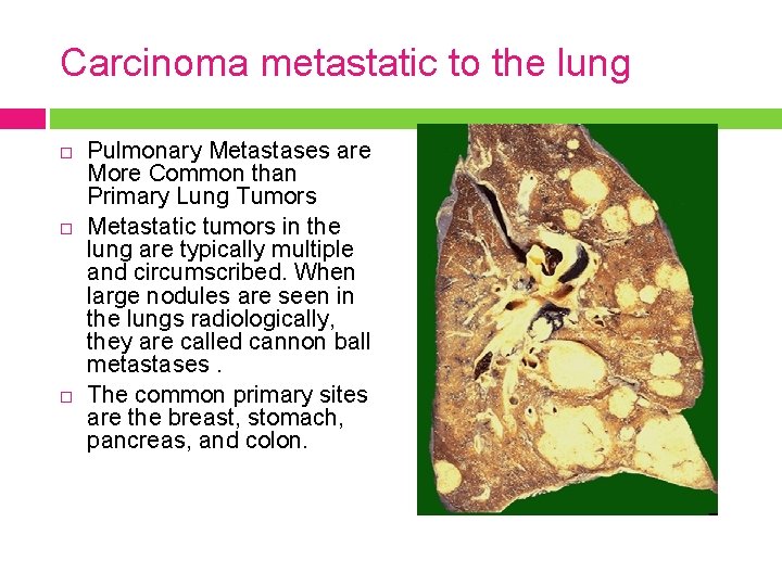 Carcinoma metastatic to the lung Pulmonary Metastases are More Common than Primary Lung Tumors