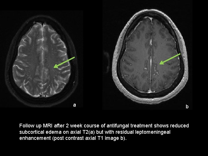 a b Follow up MRI after 2 week course of antifungal treatment shows reduced