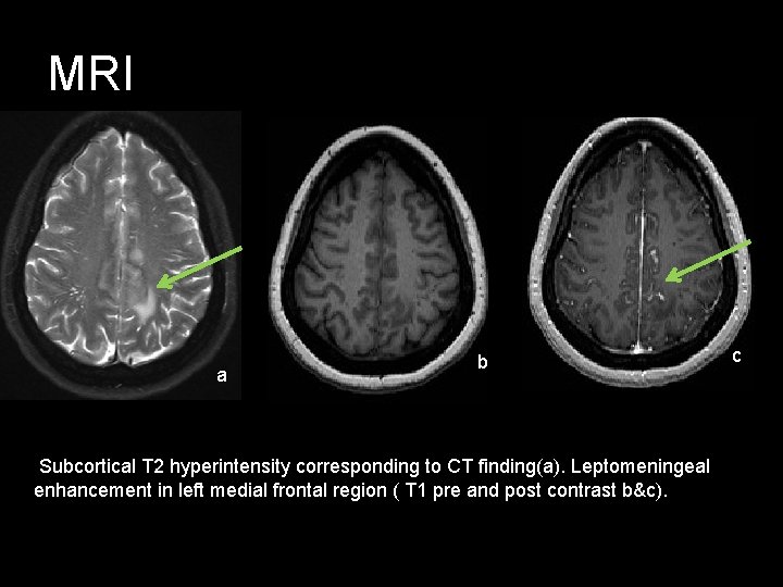 MRI a b Subcortical T 2 hyperintensity corresponding to CT finding(a). Leptomeningeal enhancement in