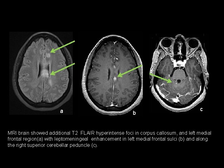 a b c MRI brain showed additional T 2 FLAIR hyperintense foci in corpus