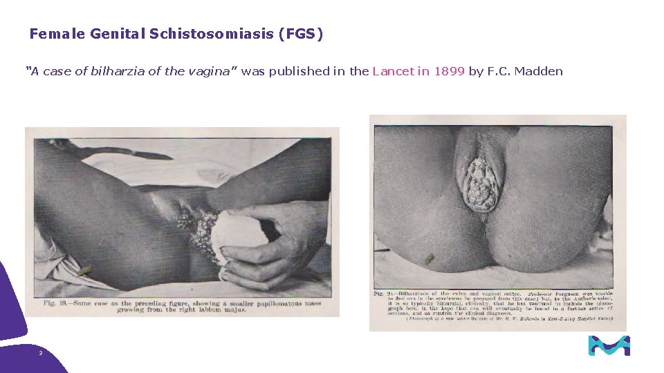 Female Genital Schistosomiasis (FGS) “A case of bilharzia of the vagina” was published in