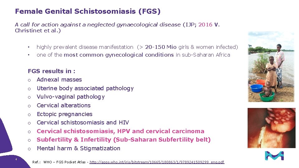 Female Genital Schistosomiasis (FGS) A call for action against a neglected gynaecological disease (IJP;