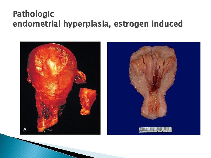 Pathologic endometrial hyperplasia, estrogen induced 