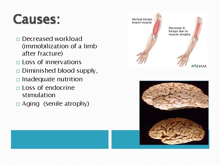 Causes: � � � Decreased workload (immobilization of a limb after fracture) Loss of