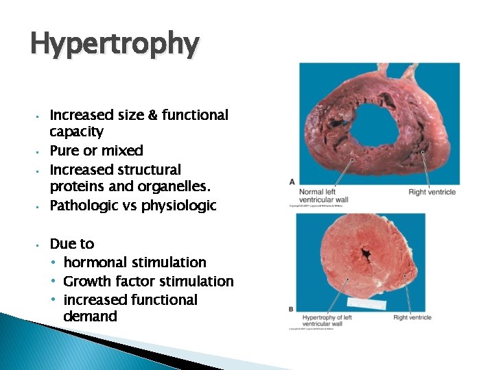 Hypertrophy • • • Increased size & functional capacity Pure or mixed Increased structural