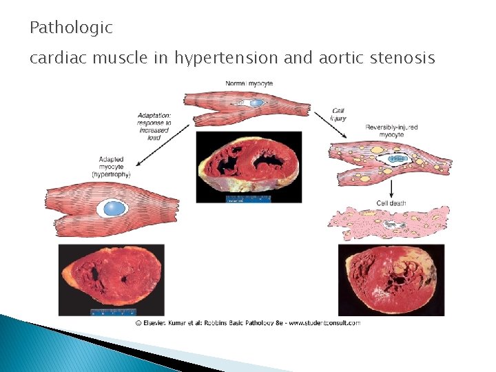 Pathologic cardiac muscle in hypertension and aortic stenosis 