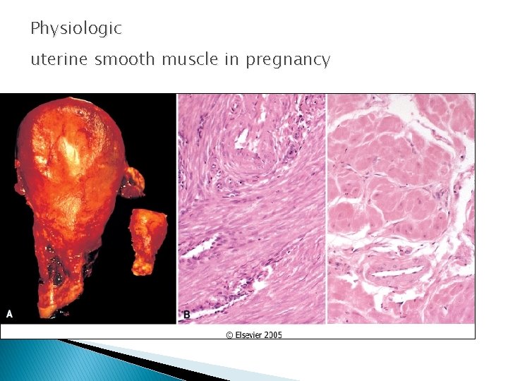 Physiologic uterine smooth muscle in pregnancy 