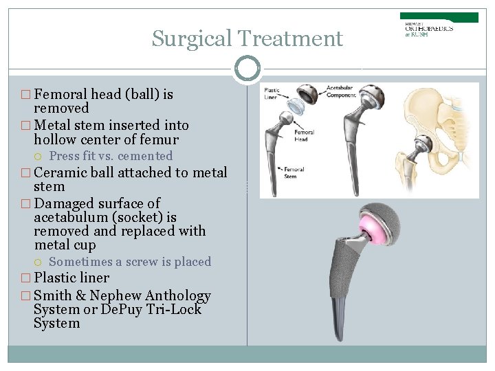 Surgical Treatment � Femoral head (ball) is removed � Metal stem inserted into hollow