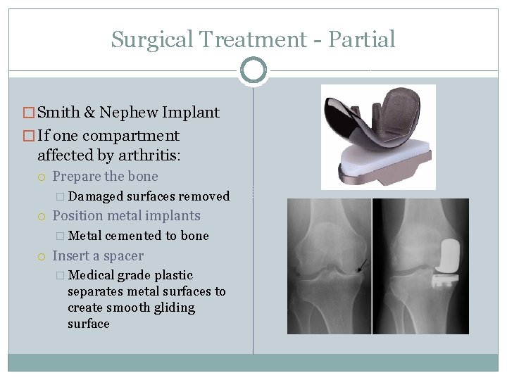Surgical Treatment - Partial � Smith & Nephew Implant � If one compartment affected