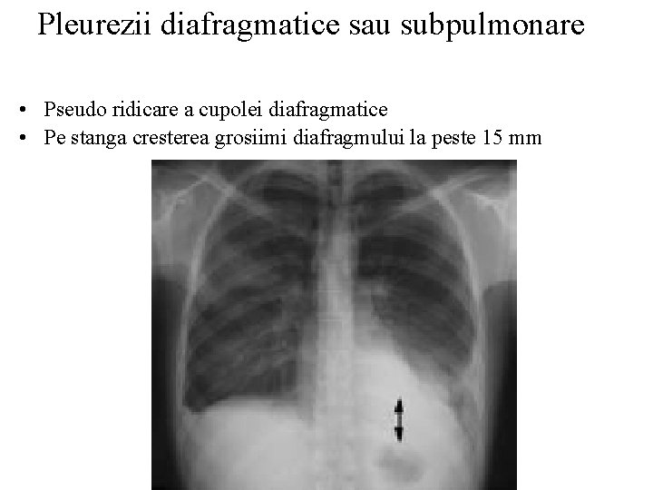 Pleurezii diafragmatice sau subpulmonare • Pseudo ridicare a cupolei diafragmatice • Pe stanga cresterea