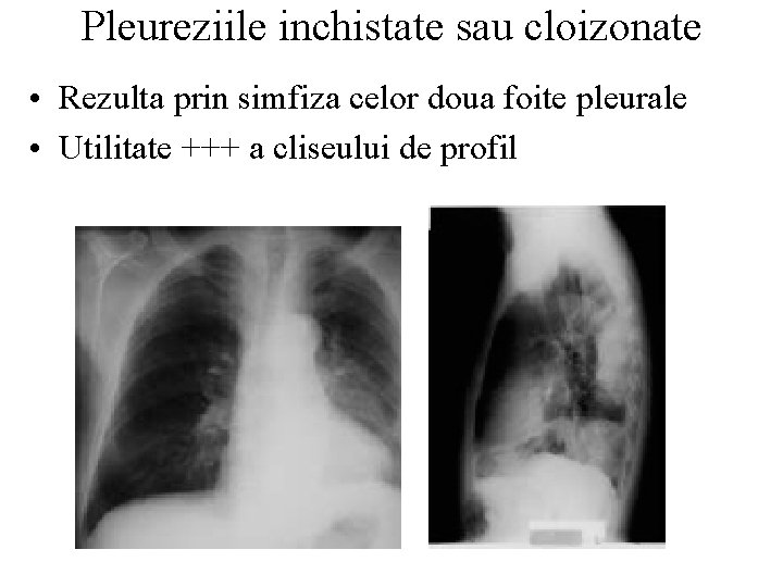 Pleureziile inchistate sau cloizonate • Rezulta prin simfiza celor doua foite pleurale • Utilitate