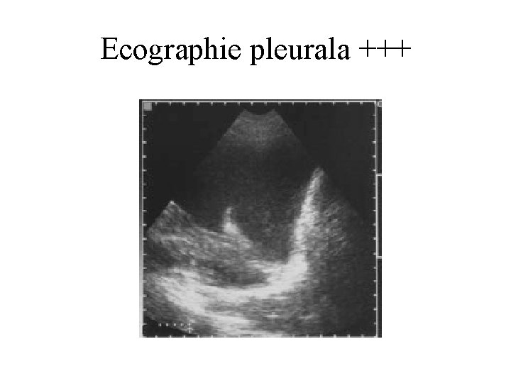 Ecographie pleurala +++ 
