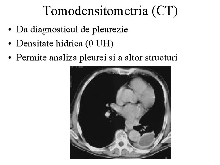 Tomodensitometria (CT) • Da diagnosticul de pleurezie • Densitate hidrica (0 UH) • Permite