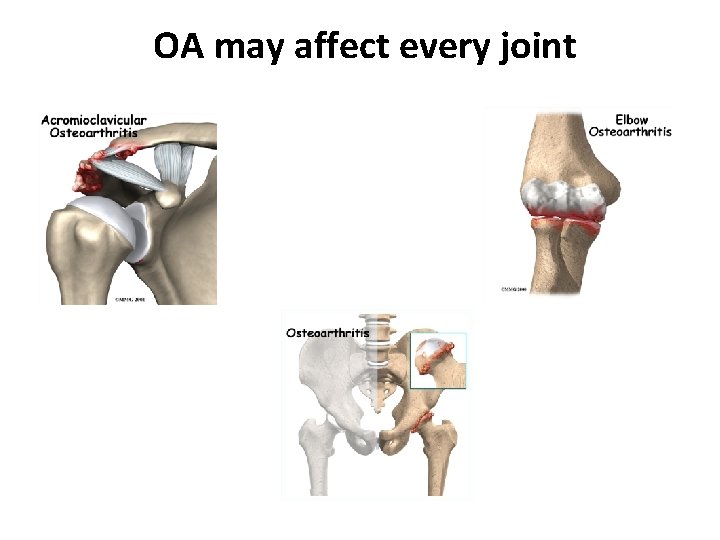 OA may affect every joint 