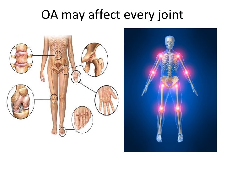OA may affect every joint 