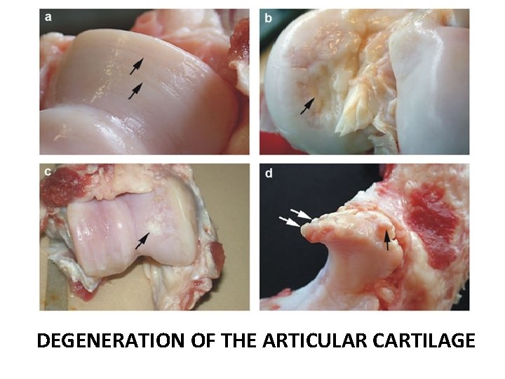 DEGENERATION OF THE ARTICULAR CARTILAGE 