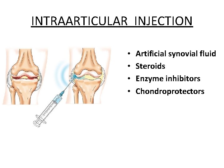 INTRAARTICULAR INJECTION • • Artificial synovial fluid Steroids Enzyme inhibitors Chondroprotectors 