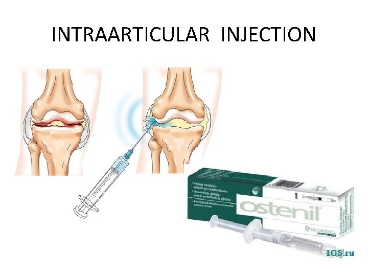 INTRAARTICULAR INJECTION 