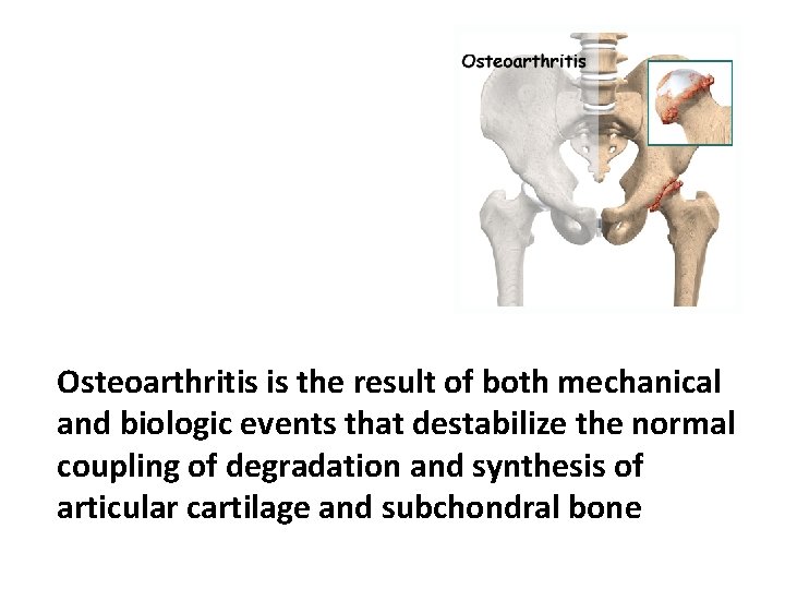 OSTEOARTHRITIS Osteoarthritis OA is a common degenerative disease