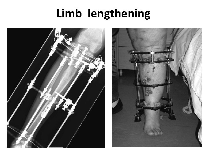 Limb lengthening 