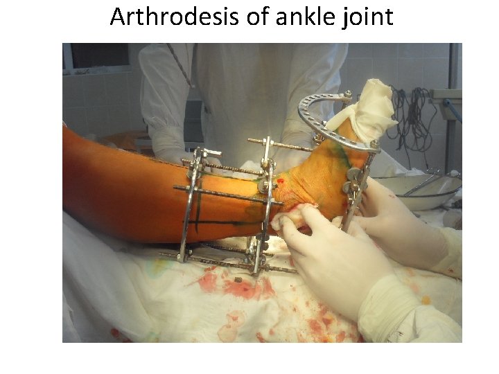 Arthrodesis of ankle joint 
