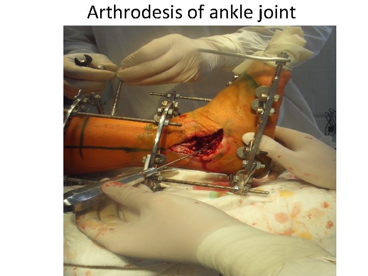 Arthrodesis of ankle joint 