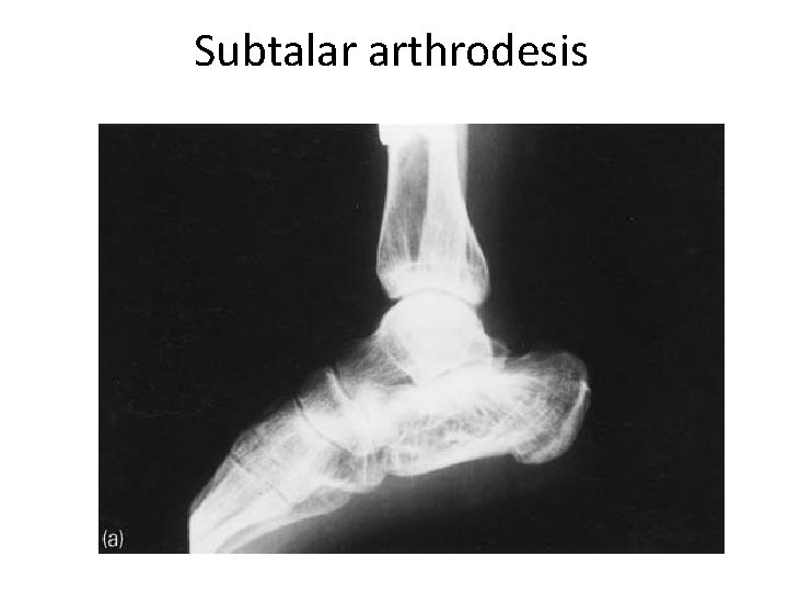 Subtalar arthrodesis 