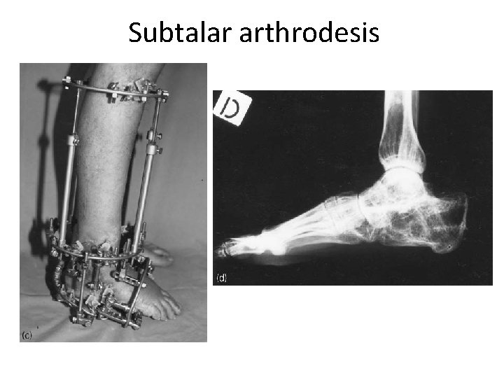 Subtalar arthrodesis 