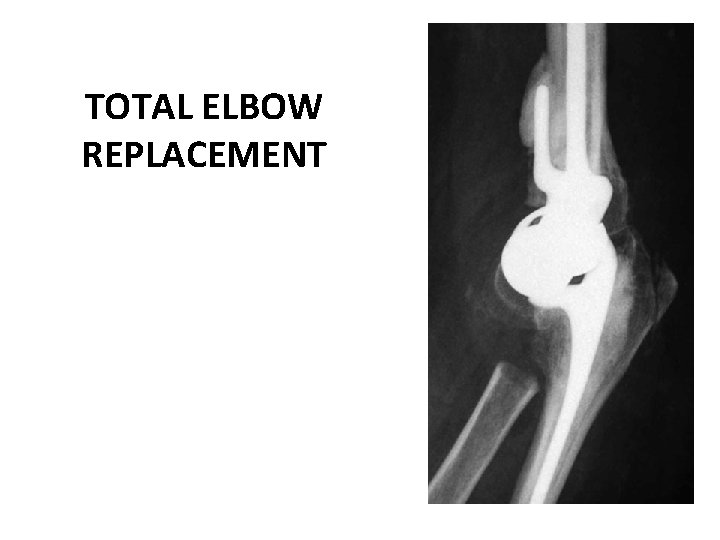 TOTAL ELBOW REPLACEMENT 