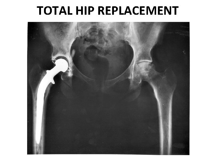 TOTAL HIP REPLACEMENT 