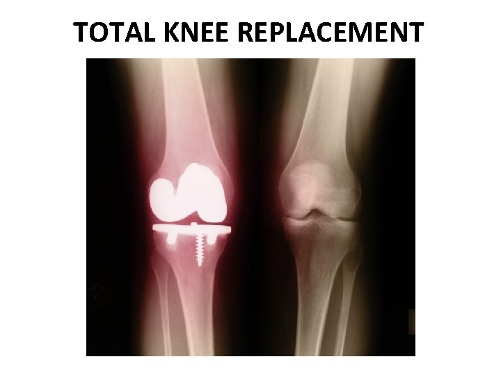TOTAL KNEE REPLACEMENT 