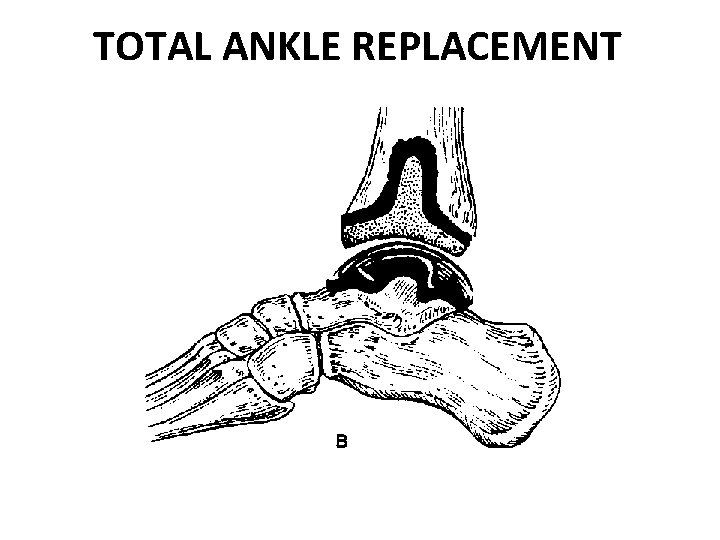 TOTAL ANKLE REPLACEMENT 