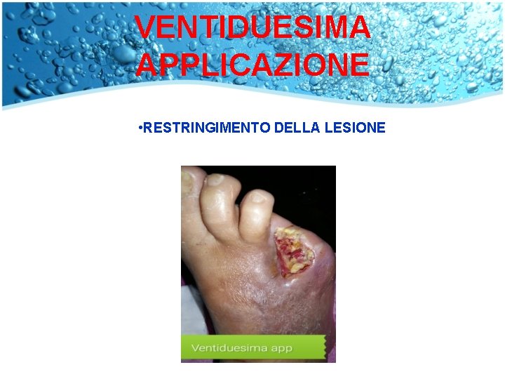 VENTIDUESIMA APPLICAZIONE • RESTRINGIMENTO DELLA LESIONE 