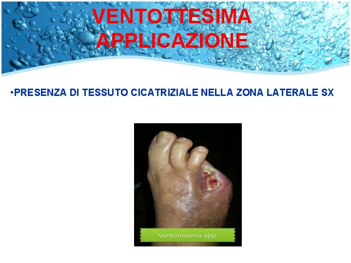 VENTOTTESIMA APPLICAZIONE • PRESENZA DI TESSUTO CICATRIZIALE NELLA ZONA LATERALE SX 