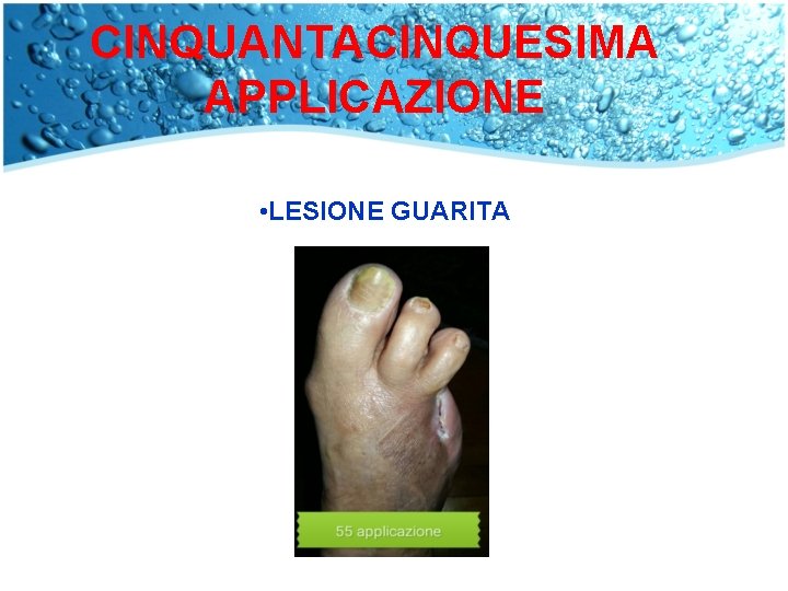 CINQUANTACINQUESIMA APPLICAZIONE • LESIONE GUARITA 