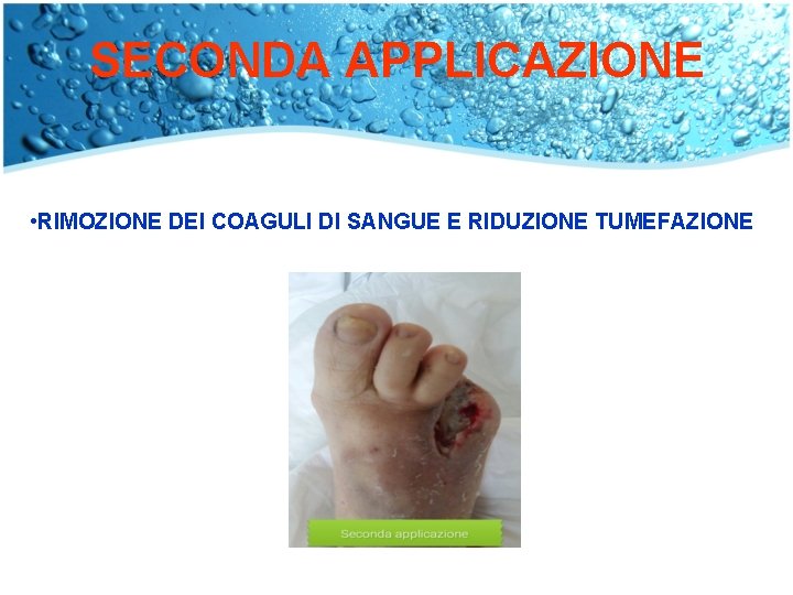 SECONDA APPLICAZIONE • RIMOZIONE DEI COAGULI DI SANGUE E RIDUZIONE TUMEFAZIONE 