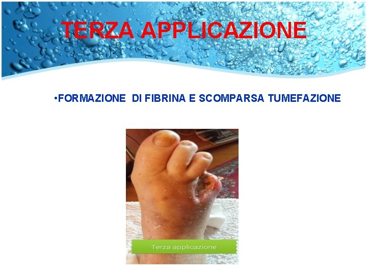 TERZA APPLICAZIONE • FORMAZIONE DI FIBRINA E SCOMPARSA TUMEFAZIONE 