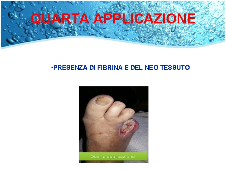 QUARTA APPLICAZIONE • PRESENZA DI FIBRINA E DEL NEO TESSUTO 