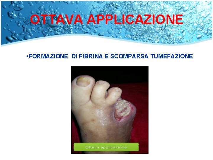 OTTAVA APPLICAZIONE • FORMAZIONE DI FIBRINA E SCOMPARSA TUMEFAZIONE 