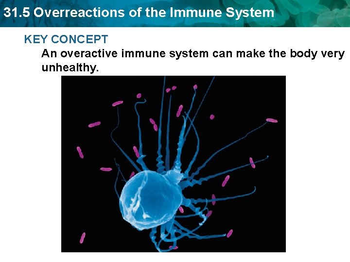 31. 5 Overreactions of the Immune System KEY CONCEPT An overactive immune system can