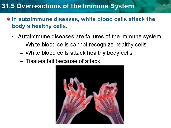 31. 5 Overreactions of the Immune System In autoimmune diseases, white blood cells attack