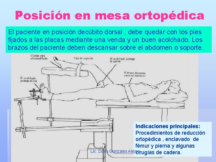 Posición en mesa ortopédica El paciente en posición decúbito dorsal , debe quedar con