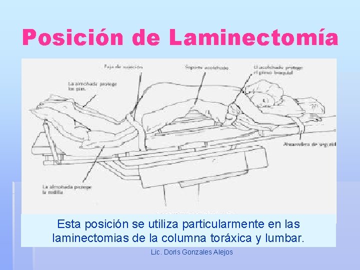 Posición de Laminectomía Esta posición se utiliza particularmente en las laminectomias de la columna