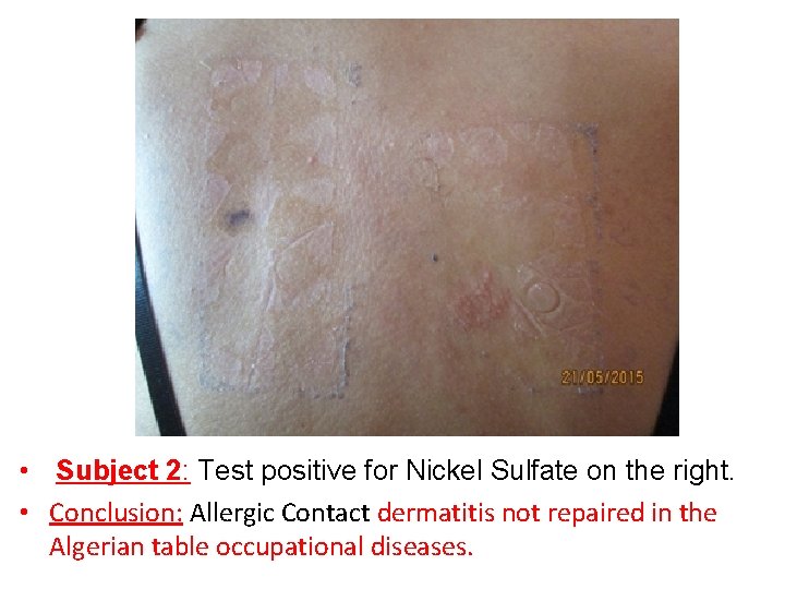  • Subject 2: Test positive for Nickel Sulfate on the right. • Conclusion: