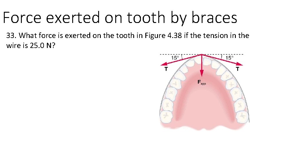 Force exerted on tooth by braces 33. What force is exerted on the tooth