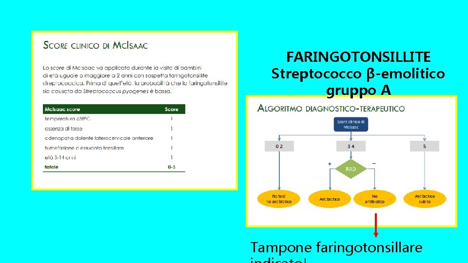 FARINGOTONSILLITE Streptococco β-emolitico gruppo A Tampone faringotonsillare 