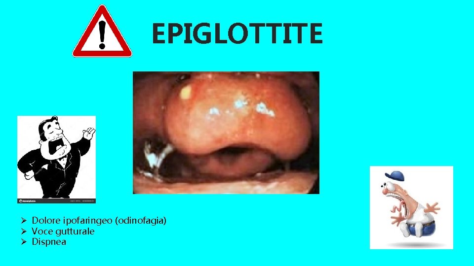 EPIGLOTTITE Ø Dolore ipofaringeo (odinofagia) Ø Voce gutturale Ø Dispnea 