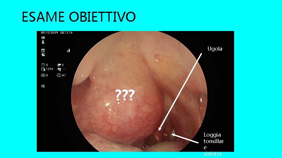 ESAME OBIETTIVO Ugola ? ? ? Loggia tonsillar e sinistra 