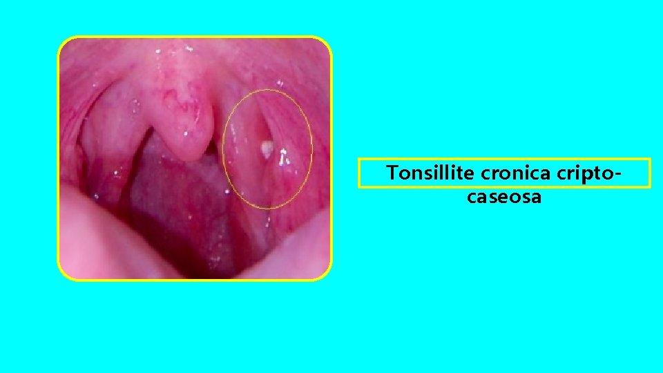 Tonsillite cronica criptocaseosa 